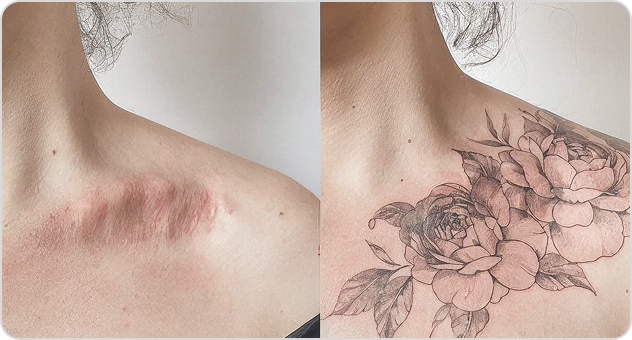 Tattoo covering a scar