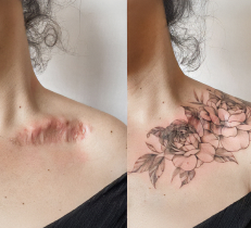 Significant Scarring